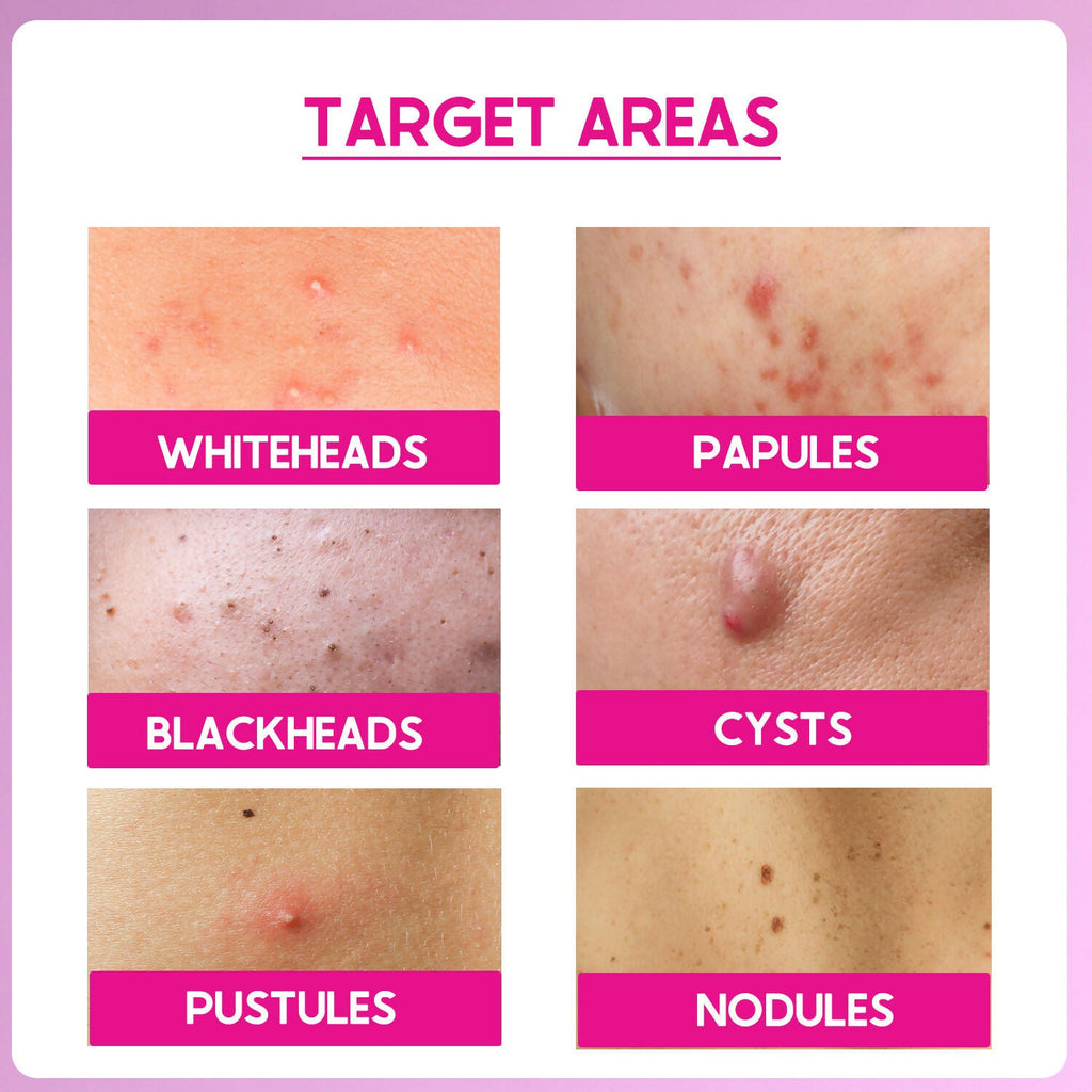 Cos-IQ ABP 33% Strong Exfoliating Peel