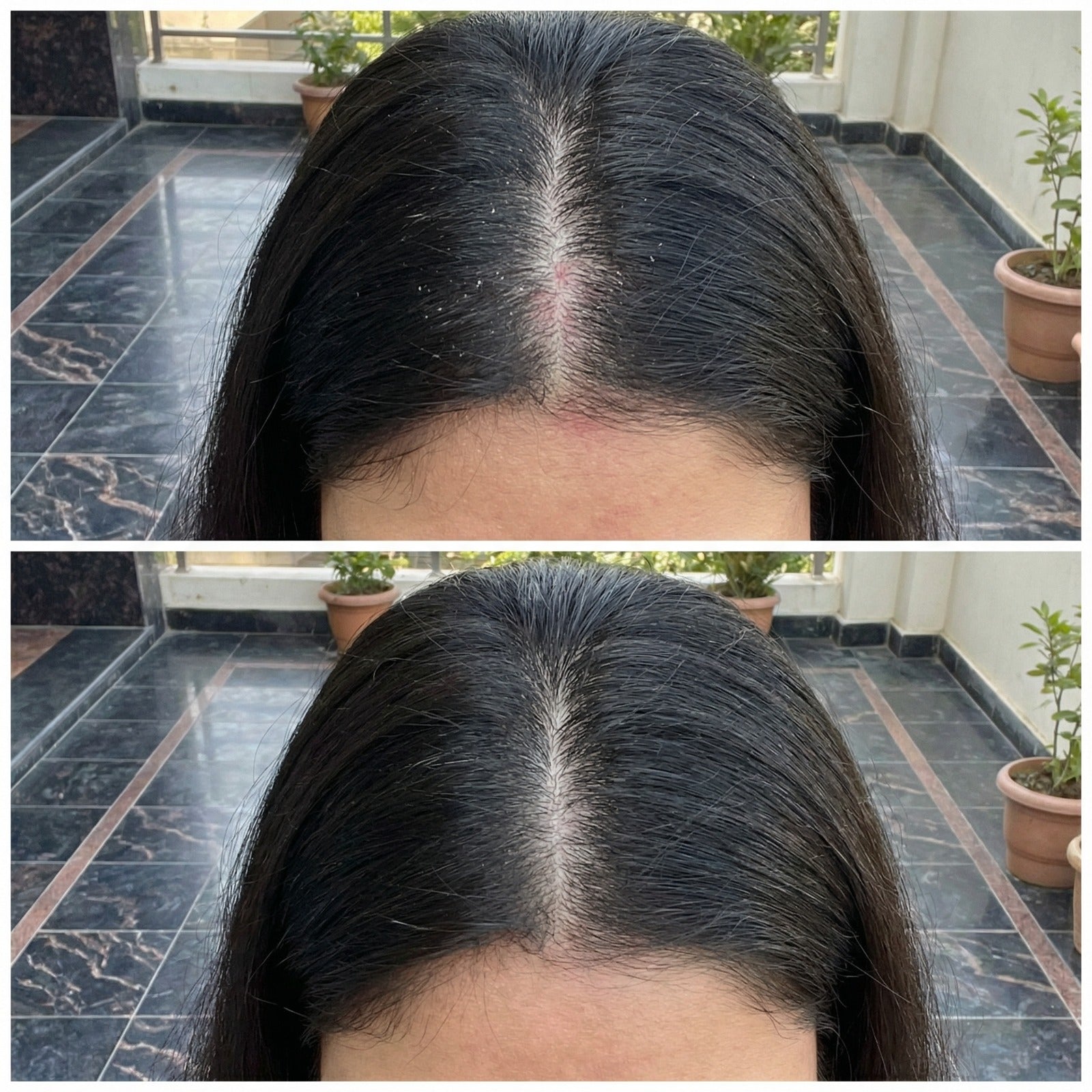 VedicDerm Sensitive Scalp Bundle for Psoriasis, Dandruff, & Itchy Scalp