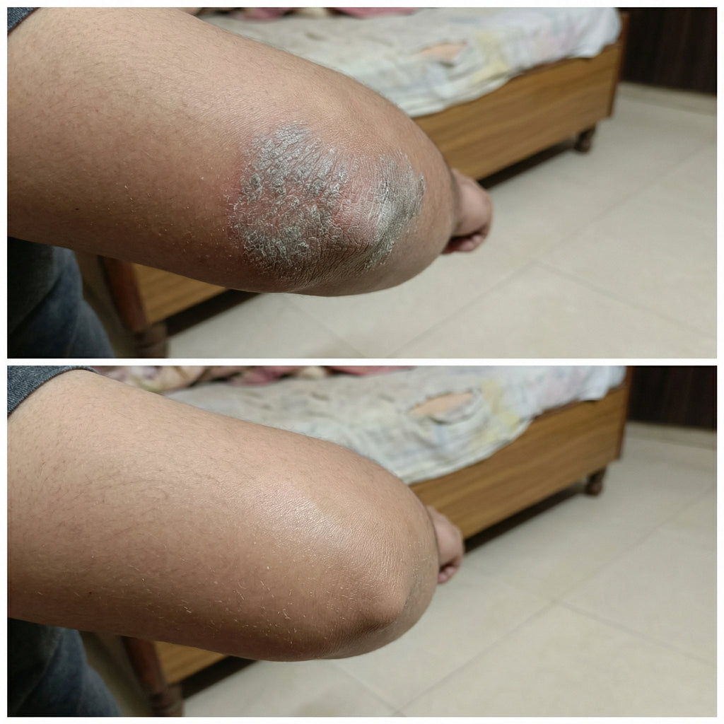 Vedicderm Psoriasis Cream