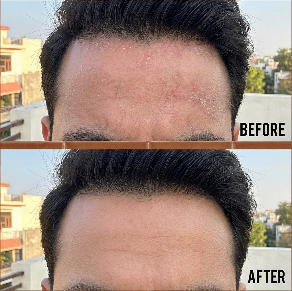 Vedicderm Psoriasis Oil 2-in-1 Skin + Scalp Relief Oil