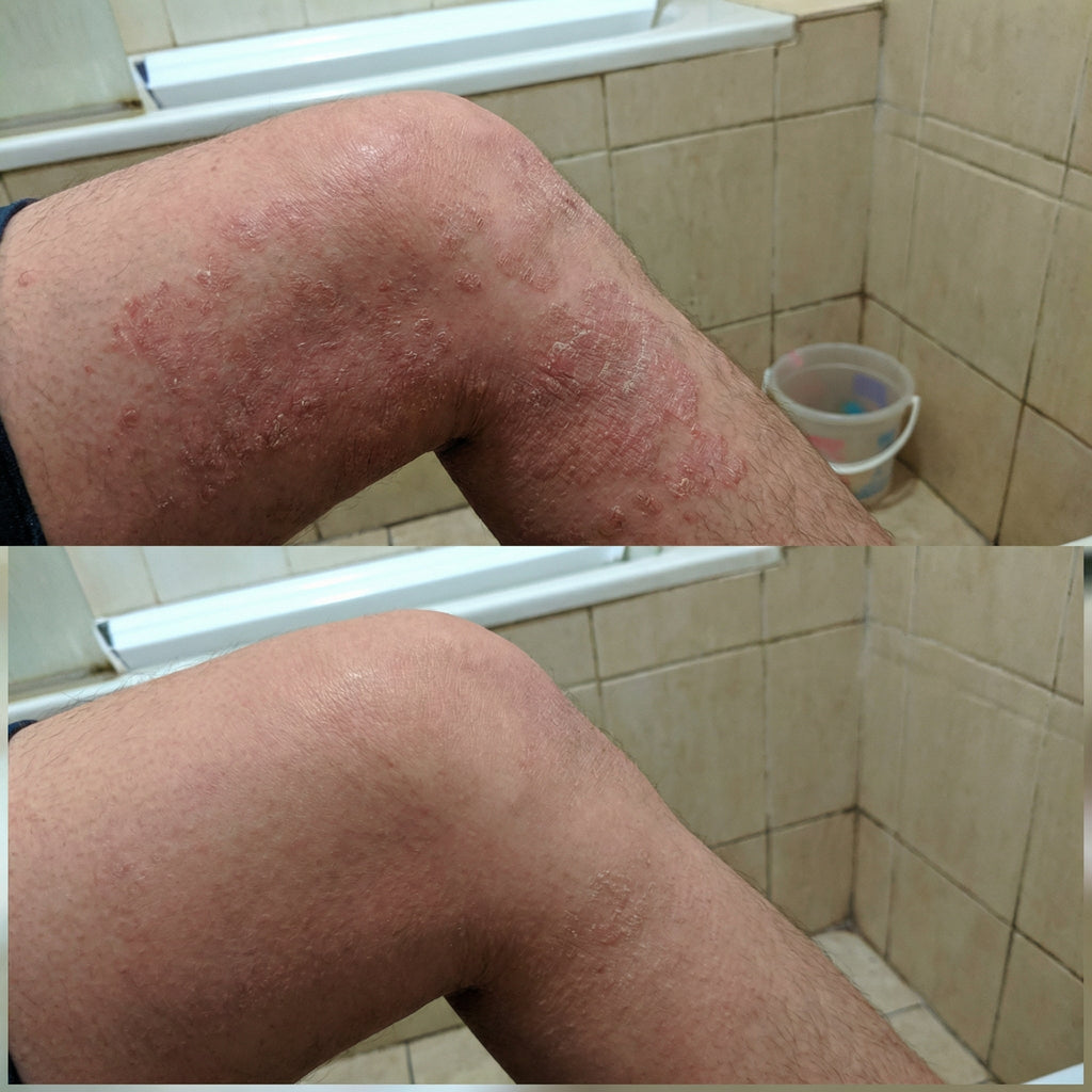 Vedicderm Psoriasis Cream